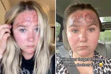 Advertencia urgente para revisar las botellas de protector solar después de que una mujer revela una 'quemadura' de horror